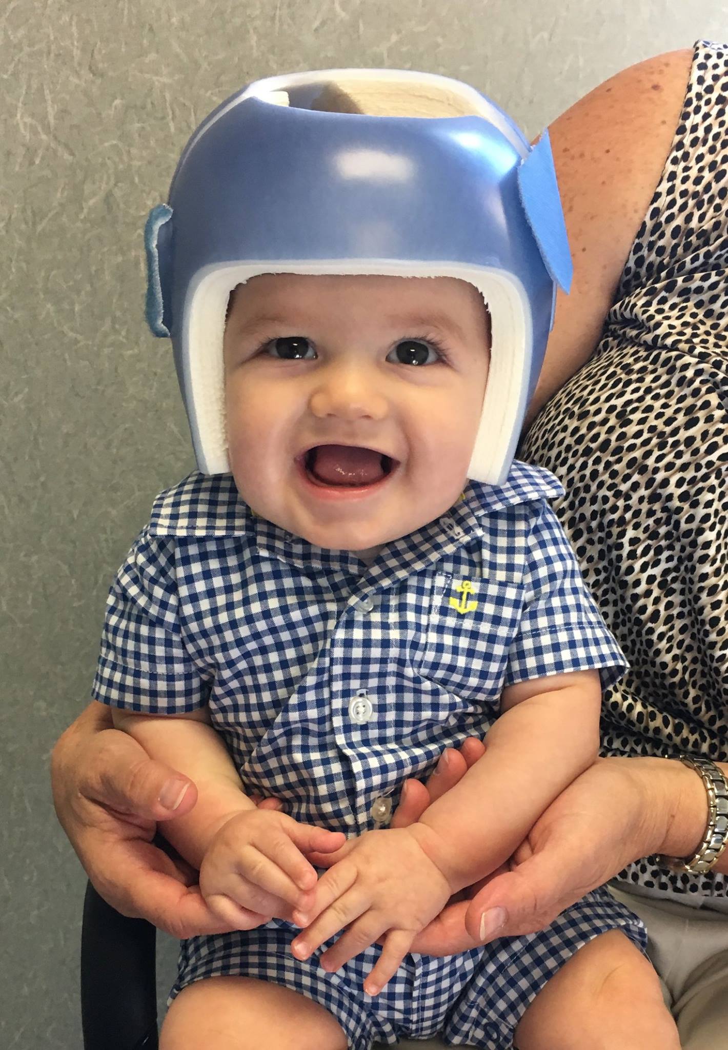 This Is A Photo Of A Child With His New Cranial Remodelling Helmet.
